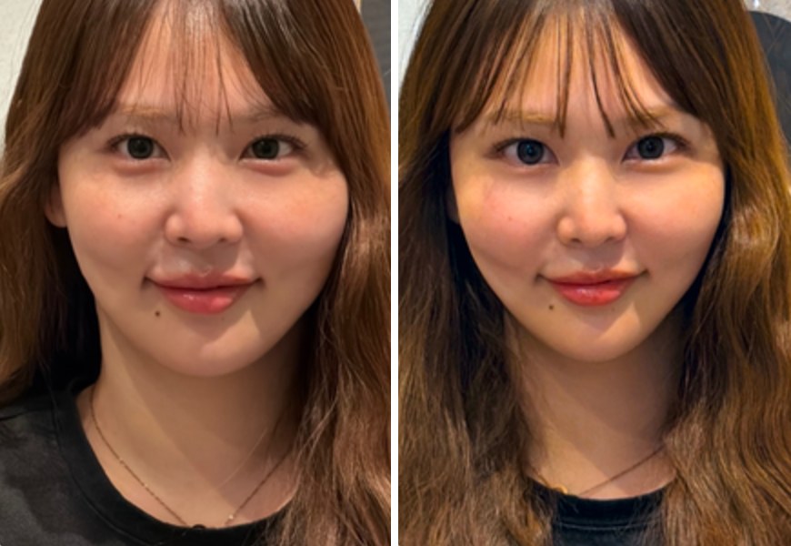 施術前と施術後の比較（顔①）